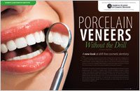 No-prep Procelain Veneers - Dear Doctor