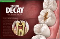 Tooth Decay � Dear Doctor Magazine