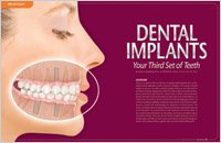 Dental Implants - Dear Doctor Magazine